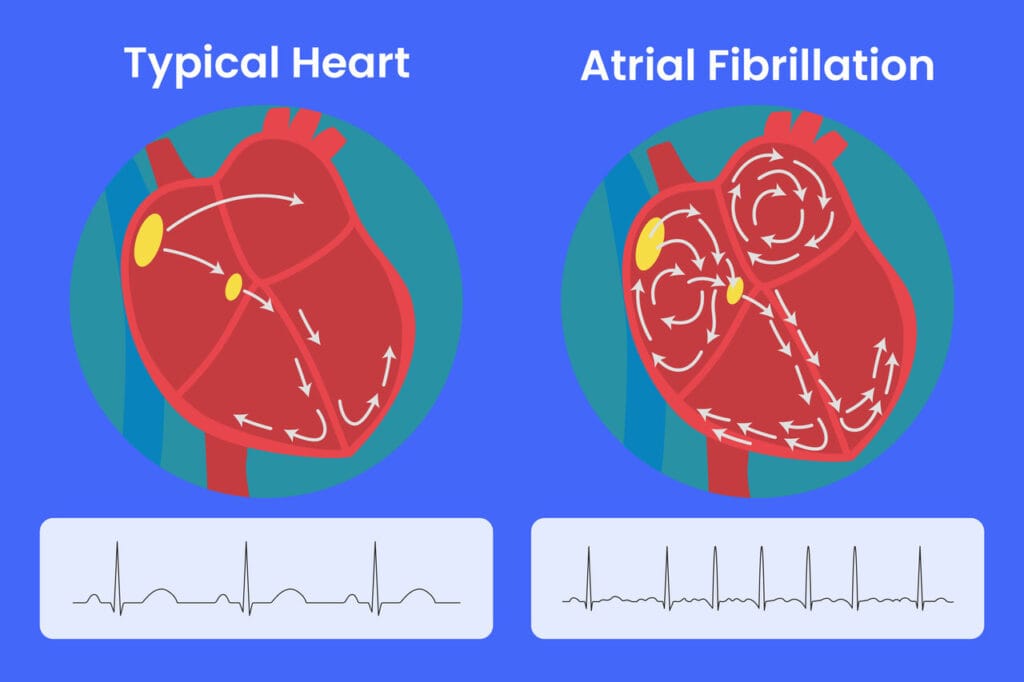 Heart-b-heart